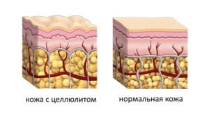 Все про зайву вагу простою і зрозумілою мовою-1