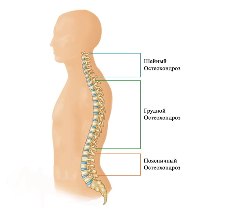 What is osteochondrosis
